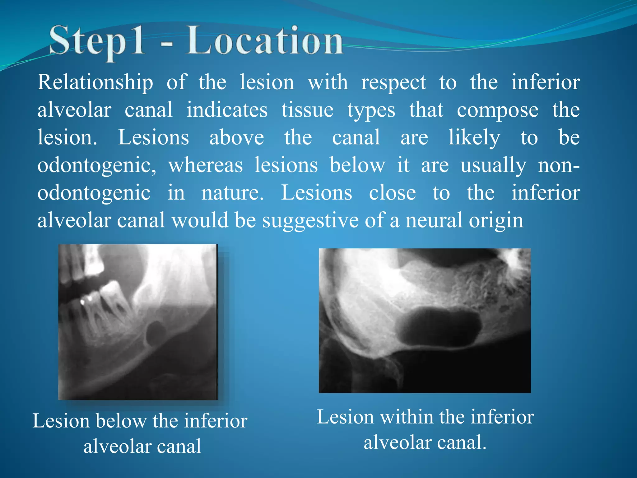 Relationship of the lesion with respect to the inferior
alveolar canal indicates tissue types that compose the
lesion. Lesions above the canal are likely to be
odontogenic, whereas lesions below it are usually non-
odontogenic in nature. Lesions close to the inferior
alveolar canal would be suggestive of a neural origin
Lesion below the inferior
alveolar canal
Lesion within the inferior
alveolar canal.
 