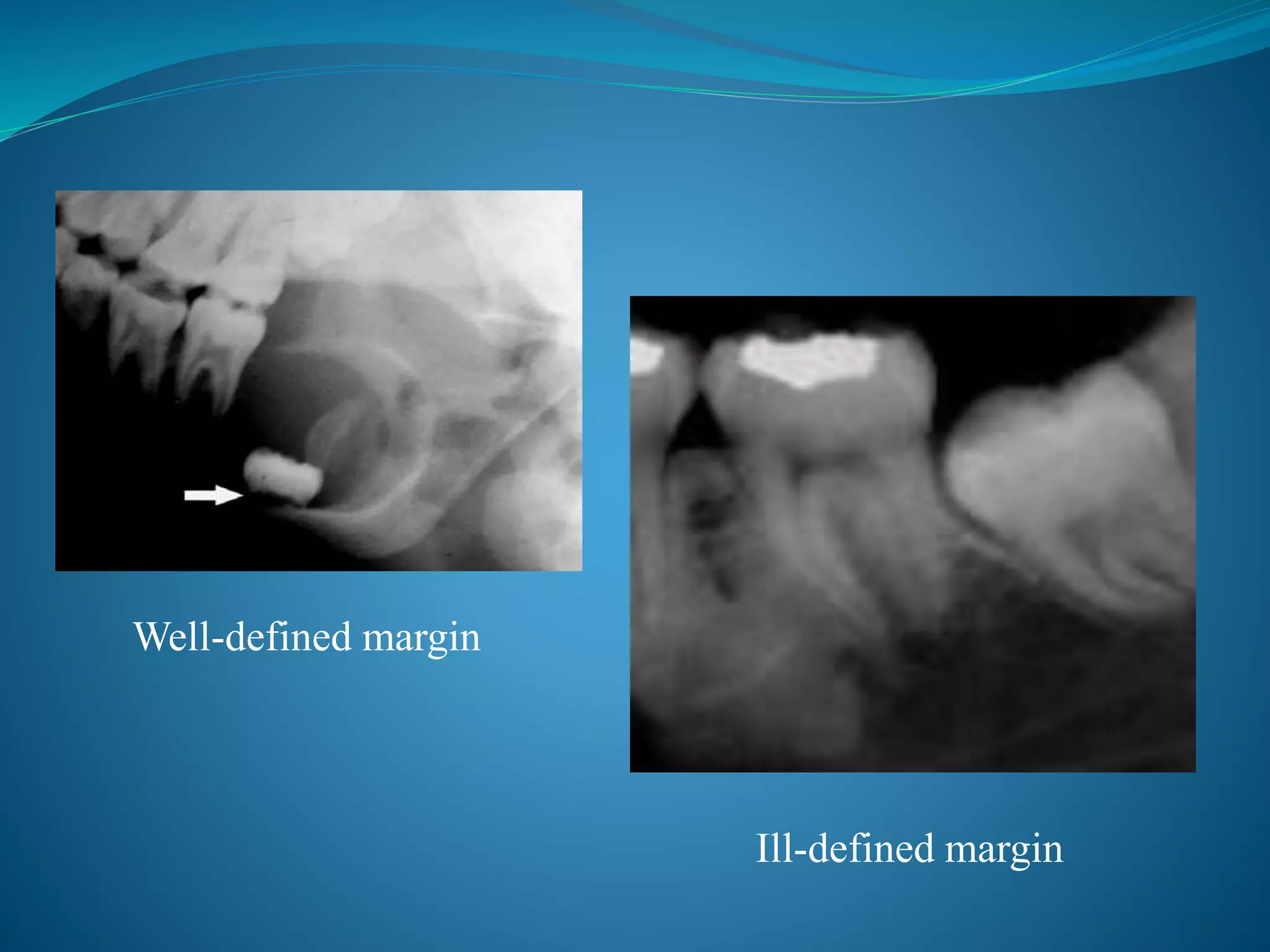 Well-defined margin
Ill-defined margin
 
