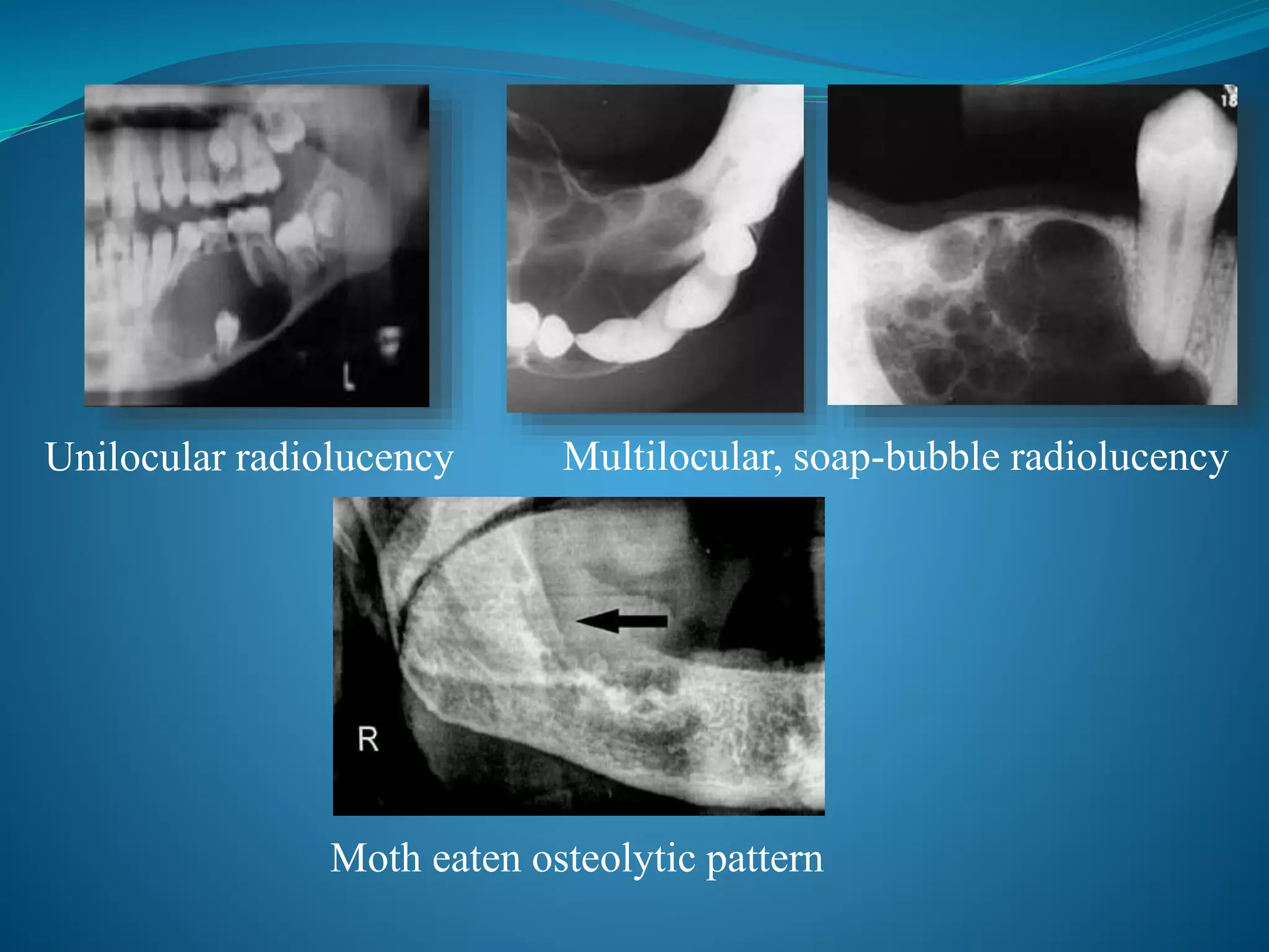 Unilocular radiolucency Multilocular, soap-bubble radiolucency
Moth eaten osteolytic pattern
 