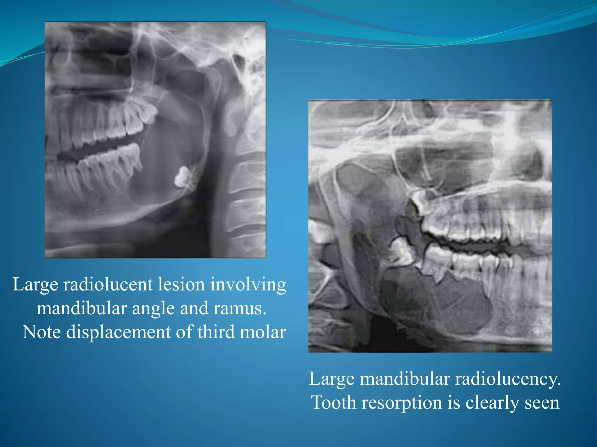Large radiolucent lesion involving
mandibular angle and ramus.
Note displacement of third molar
Large mandibular radiolucency.
Tooth resorption is clearly seen
 