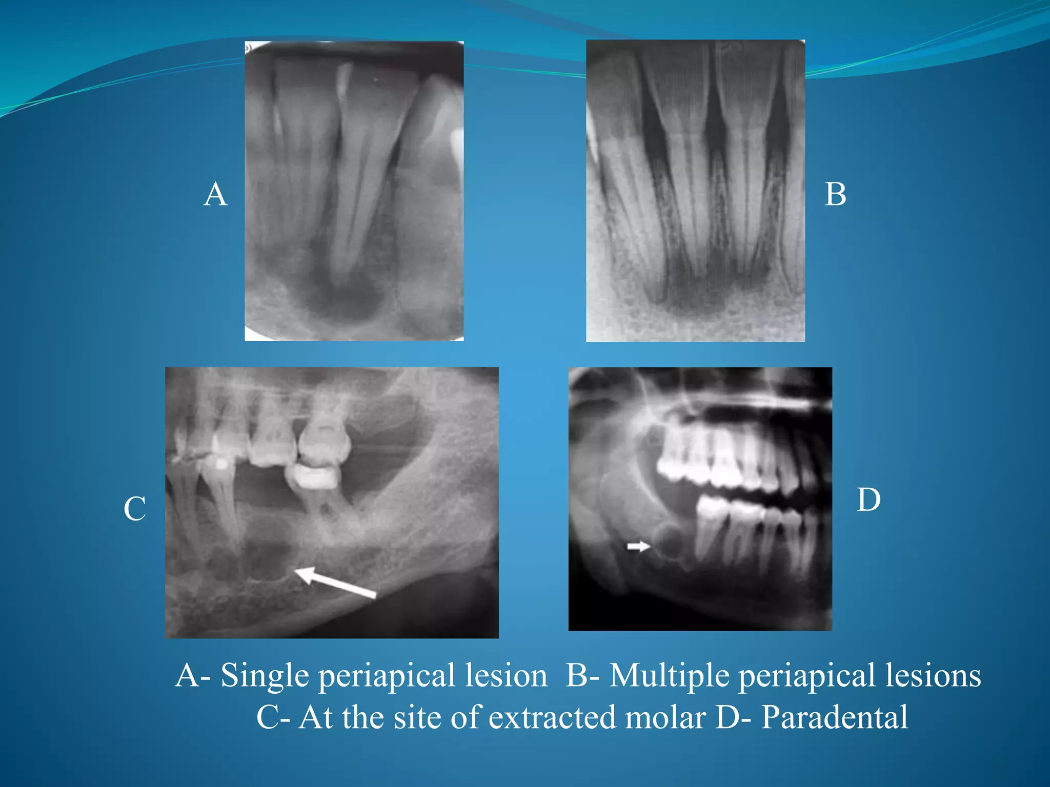 A B
C D
A- Single periapical lesion B- Multiple periapical lesions
C- At the site of extracted molar D- Paradental
 