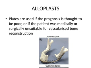 ALLOPLASTS
• Plates are used if the prognosis is thought to
be poor, or if the patient was medically or
surgically unsuitable for vascularised bone
reconstruction
 