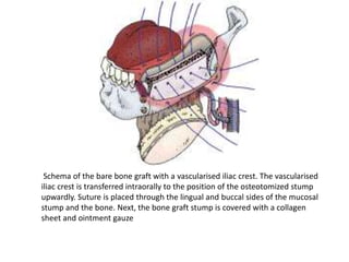 Schema of the bare bone graft with a vascularised iliac crest. The vascularised
iliac crest is transferred intraorally to the position of the osteotomized stump
upwardly. Suture is placed through the lingual and buccal sides of the mucosal
stump and the bone. Next, the bone graft stump is covered with a collagen
sheet and ointment gauze
 