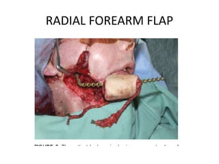RADIAL FOREARM FLAP
 