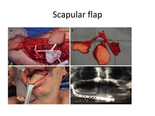 Scapular flap
 