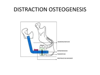 DISTRACTION OSTEOGENESIS
 