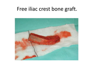 Free iliac crest bone graft.
 