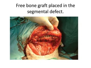 Free bone graft placed in the
segmental defect.
 