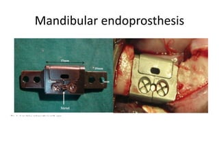 Mandibular endoprosthesis
 