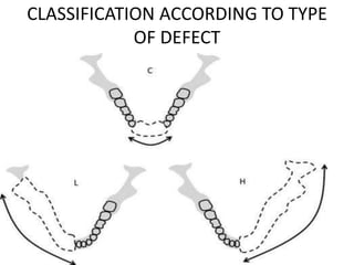 CLASSIFICATION ACCORDING TO TYPE
OF DEFECT
 