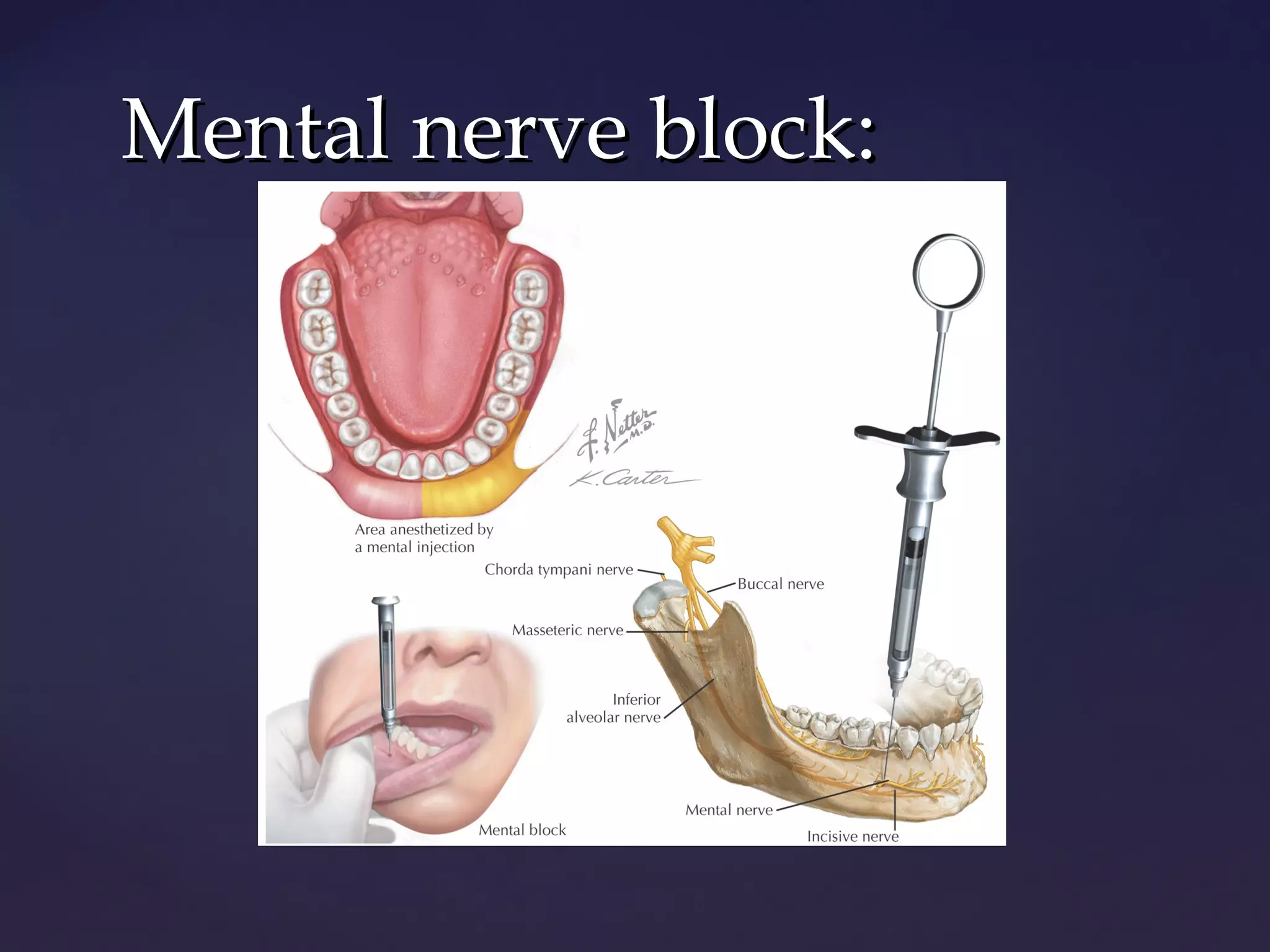 Mandibular block techniques | PPT