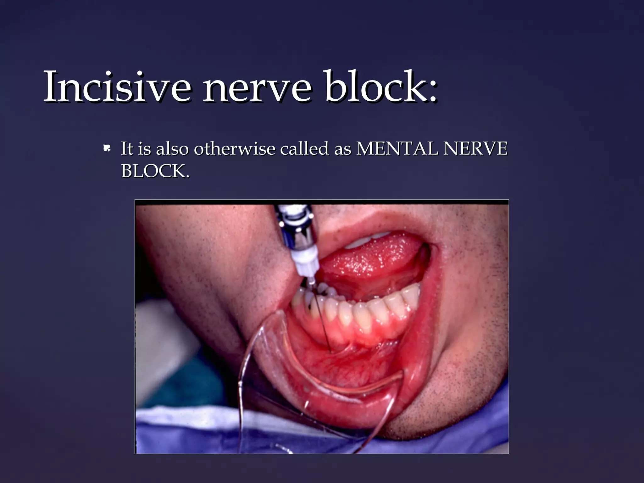 Mandibular block techniques | PPT