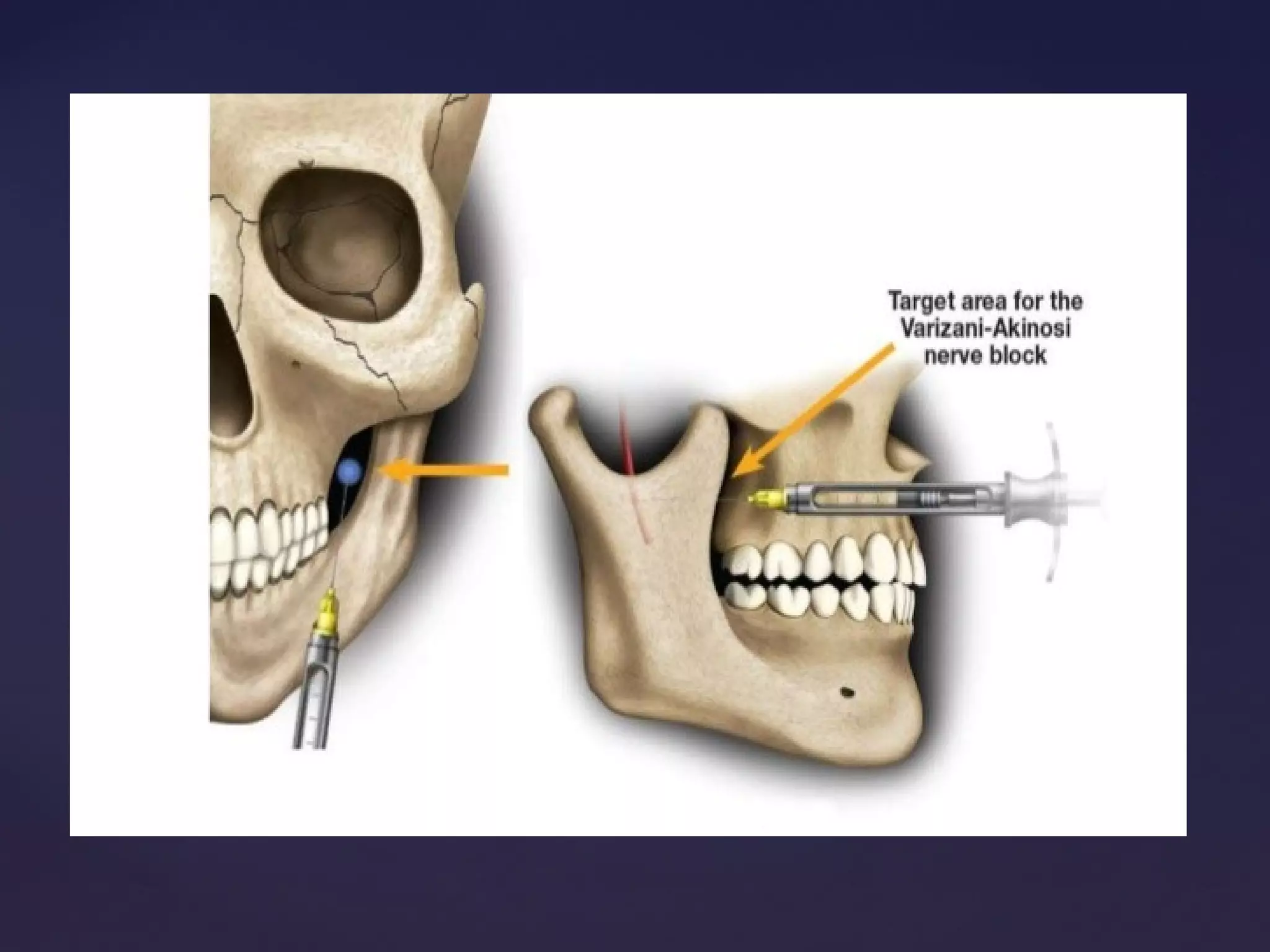 Mandibular block techniques | PPT