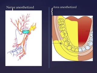 Mandibular block techniques | PPT