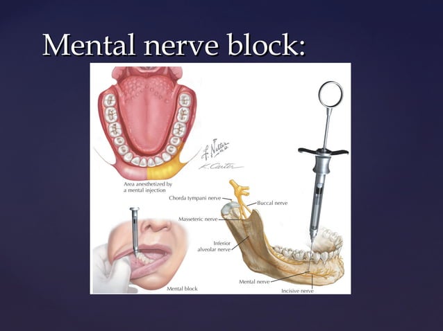 Mandibular block techniques | PPT | First Aid | Injuries