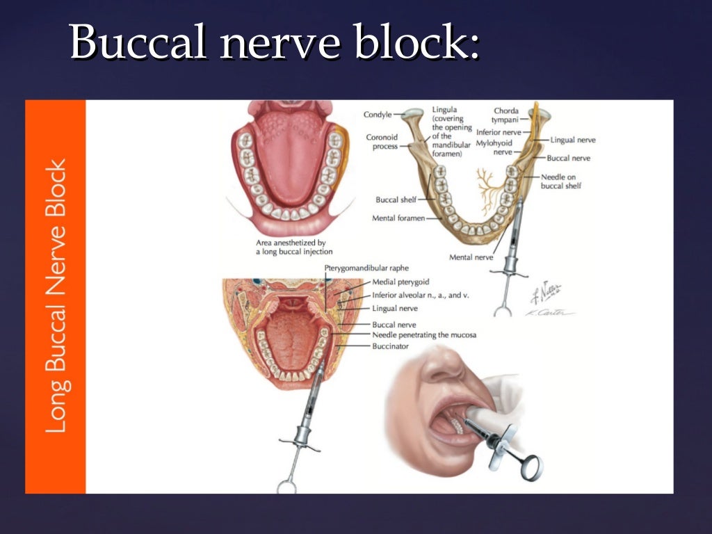 Mandibular block techniques