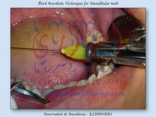Mandibular teeth anesthetic block techniques | PDF
