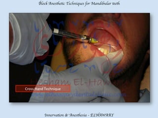 Mandibular teeth anesthetic block techniques | PDF