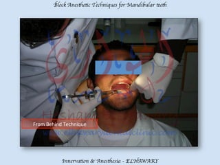 Mandibular teeth anesthetic block techniques | PDF