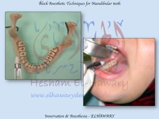 Mandibular teeth anesthetic block techniques | PDF