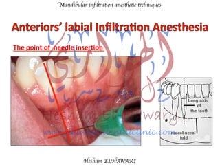Mandibular inﬁltration anesthetic techniques
Hesham ELHAWARY
The	
  point	
  of	
  	
  needle	
  inser'on	
  	
  
 