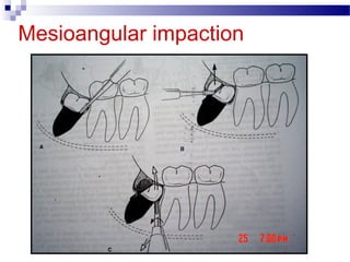 Mandibular third moalr impaction | PPT
