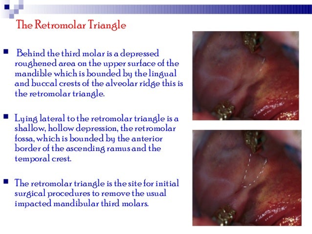 Mandibular third moalr impaction
