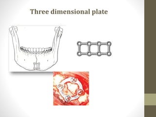 Mandibular trauma | PPTX