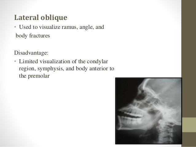 treatment of mandibular fractures by means of compression osteosynthesis Treatment ðšconservative ð§lag technique compression of fracture screw must be perpendicular to #, overdrill near cortex so that threads engage only the far cortex = compression ð§not. treatment of mandibular fractures by means of compression osteosynthesis Treatment ðšconservative ð§lag technique compression of fracture screw must be perpendicular to #, overdrill near cortex so that threads engage only the far cortex = compression ð§not.