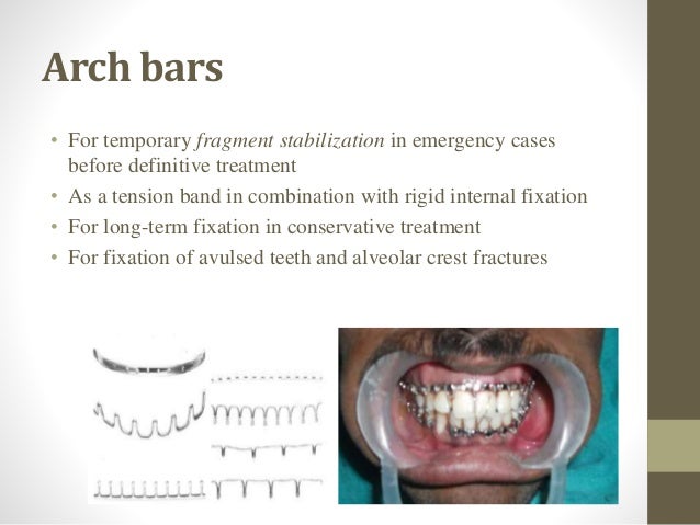 Circummandibular wiring procedure picture