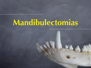 Mandibulectomias
 