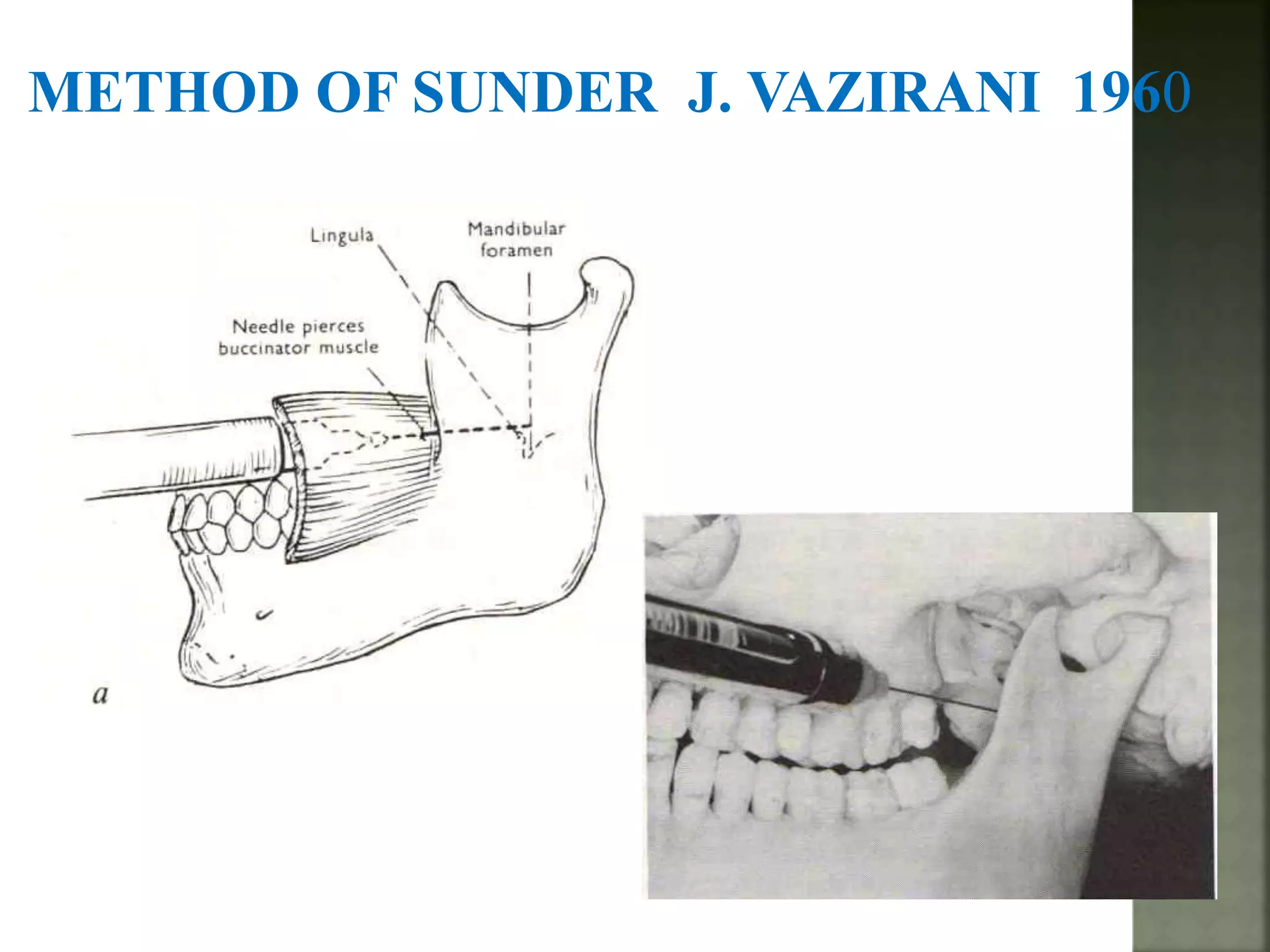 Mandibular nerve blocks techniques | PPTX