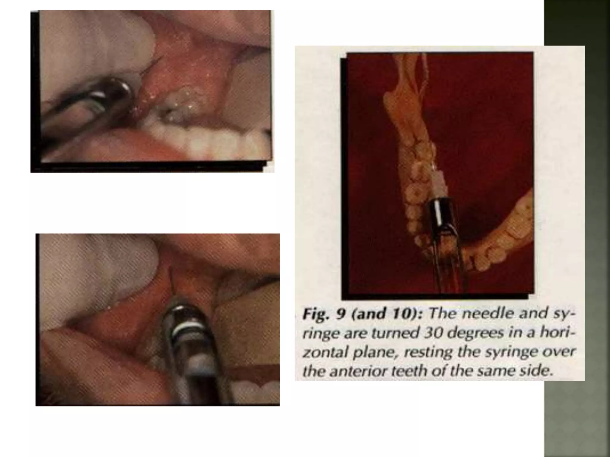Mandibular nerve blocks techniques | PPTX