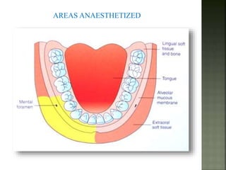 Mandibular nerve blocks techniques | PPTX