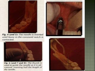 Mandibular nerve blocks techniques | PPTX