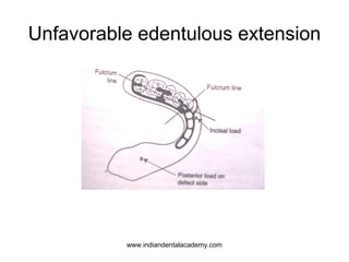 Unfavorable edentulous extension

www.indiandentalacademy.com

 