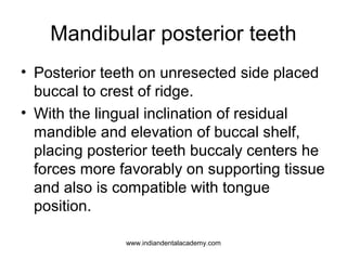 Mandibular posterior teeth
• Posterior teeth on unresected side placed
buccal to crest of ridge.
• With the lingual inclin...