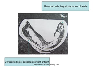 Resected side, lingual placement of teeth

Unresected side, buccal placement of teeth
www.indiandentalacademy.com

 