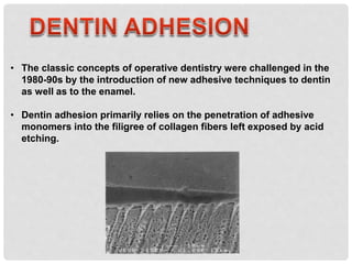 • The classic concepts of operative dentistry were challenged in the
1980-90s by the introduction of new adhesive techniques to dentin
as well as to the enamel.
• Dentin adhesion primarily relies on the penetration of adhesive
monomers into the filigree of collagen fibers left exposed by acid
etching.
 