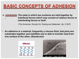 The state in which two surfaces are held together by
interfacial forces which may consist of valance forces or
interlocking forces or both.
 ADHESION
:
(The American Society for Testing and Materials Sp. D 907)
• An adhesive is a material, frequently a viscous fluid, that joins two
substrates together and solidifies and is able to transfer load from
one surface to the other. (Sturdevant)
 