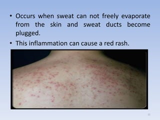 • Occurs when sweat can not freely evaporate
from the skin and sweat ducts become
plugged.
• This inflammation can cause a red rash.
11
 