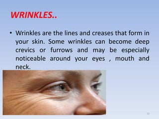WRINKLES..
• Wrinkles are the lines and creases that form in
your skin. Some wrinkles can become deep
crevics or furrows and may be especially
noticeable around your eyes , mouth and
neck.
12
 