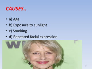 CAUSES..
• a) Age
• b) Exposure to sunlight
• c) Smoking
• d) Repeated facial expression
13
 