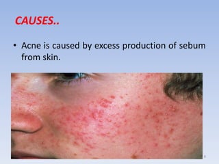 CAUSES..
• Acne is caused by excess production of sebum
from skin.
8
 