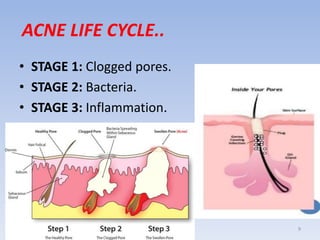 ACNE LIFE CYCLE..
• STAGE 1: Clogged pores.
• STAGE 2: Bacteria.
• STAGE 3: Inflammation.
9
 