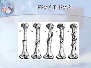 FRACTURASFRACTURAS
 