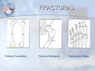 Fractura Traumática Fractura Patológica Fractura por Fatiga
FRACTURASFRACTURAS
 