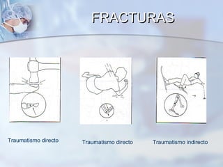 Traumatismo directo Traumatismo directo Traumatismo indirecto
FRACTURASFRACTURAS
 