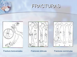 Fractura transversales Fracturas oblicuas Fracturas conminutas
FRACTURASFRACTURAS
 