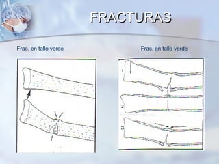 Frac. en tallo verde Frac. en tallo verde
FRACTURASFRACTURAS
 